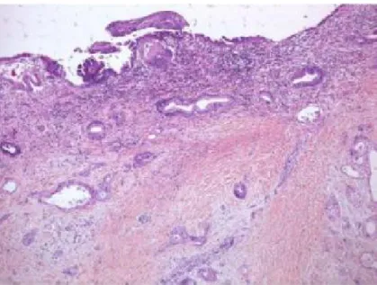 Fig 13 : aspect microscopique d’un cystadénocarcinome mucineux  (CKM) invasif [26] 