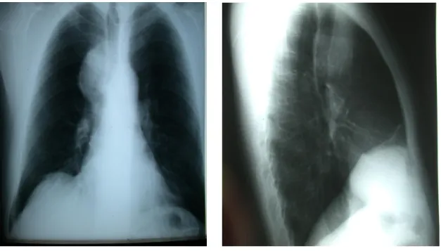 Fig. 25 : Radiographie thoracique de face   Fig.26 : Radiographie thoracique de profil 