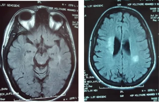 Figure 5 : IRM cérébrale, coupes axiales, en séquence Flair montrant  l’apparition de nouvelles lésions paraventriculaires,  