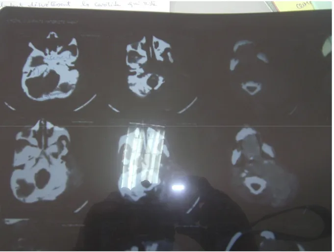 Figure 10 : TDM cervicale de la patiente montrant la masse en question 