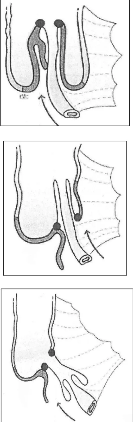 Figure 1 Différent type d'invaginations intestinales aiguës. 