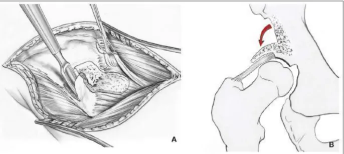 Fig.  18 :  Technique  de  Lance.  A.  Prélèvement  des  greffons.  B.  Abaissement  des  greffons