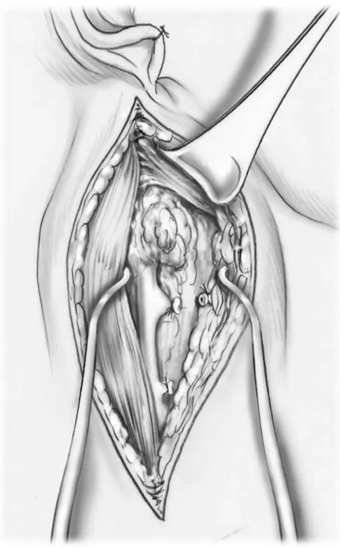Figure 14 [22]  Le bord antérieur de la veine jugulaire interne est  libéré et le  tronc thyrobilinguofacial a été lié