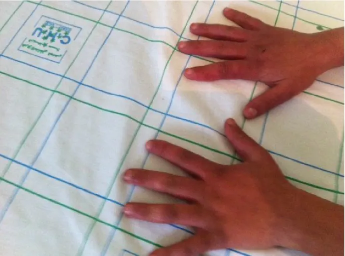 Fig. 1 : phénomène de raynaud 