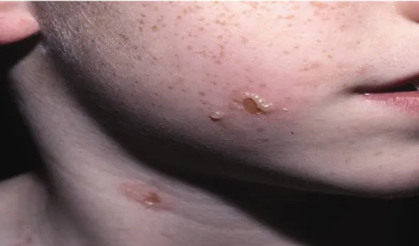 Figure 12 : Lésions vésiculo-bulleuses disposées en rosette au niveau de la région périorale  chez un enfant 
