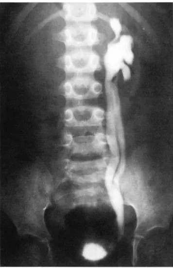 Figure N 0 4 : Cystographie (UCRM). Reflux dans les deux pyélons d'une bifidité 