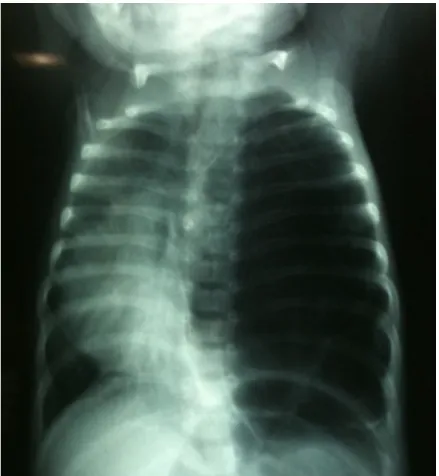 Figure N°6 : Radiographie pulmonaire montrant une hyperclartée   gauche et un refoulement médiastinal à droite