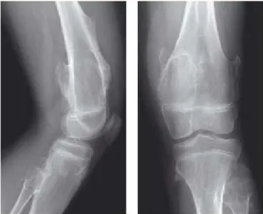 Figure n°2  :   Radiographie du genou d’un patient porteur d’une maladie exostosante    associant exostose sessile et pédiculée, déviation en valgus et   