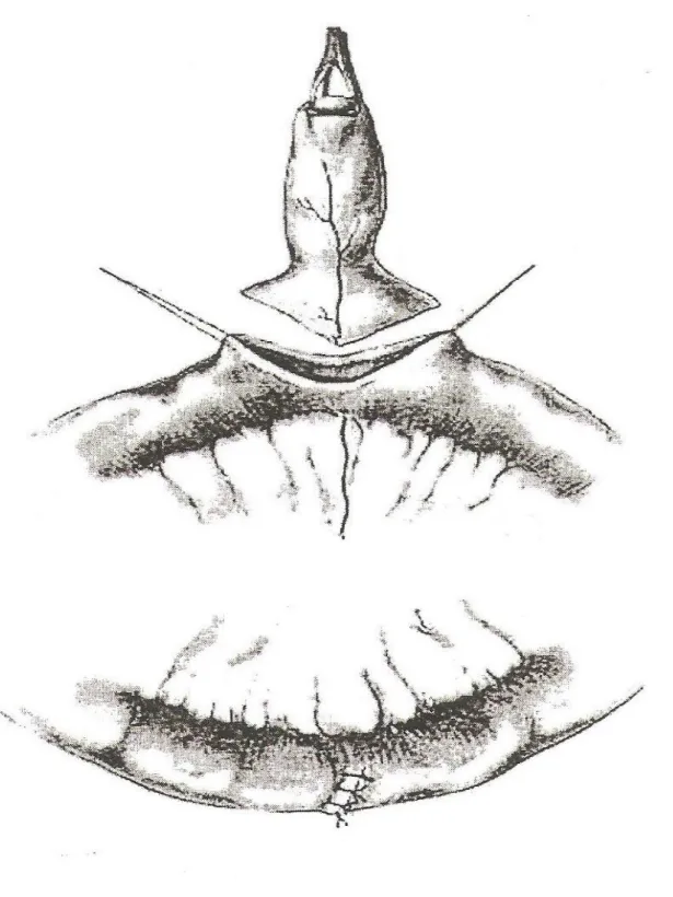 Figure 11  Résection cunéiforme du DM avec hémostase de l’artère et sutures transverses à  point séparés