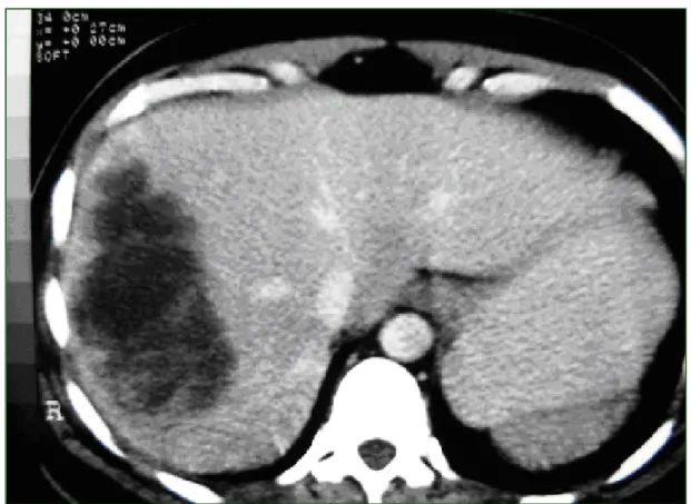 Figure  4 :  Tomodensitométrie  hépatique  avec  injection  de  produit  de  contraste: 