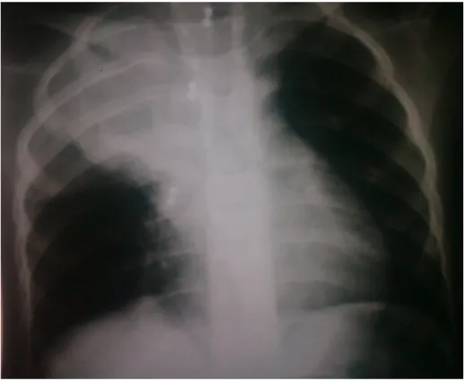 Figure 3 : Radiographie thoracique montrant une masse   Médiastino-pulmonaire  