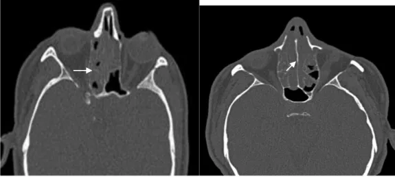 Fig. 11: Lyse et déminéralisation diffuse des cloisons osseuses ethmoïdales: polypose  naso-sinusienne