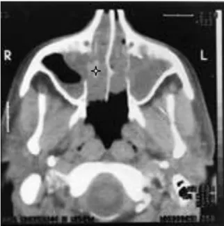 Fig. 12 : Lyse de la paroi interne du sinus maxillaire droit: polypose naso-sinusienne