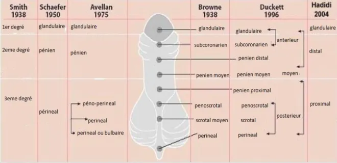 Figure 18 : Les  différentes  classifications  de  l’hypospadias  selon  la  position du méat [74] 