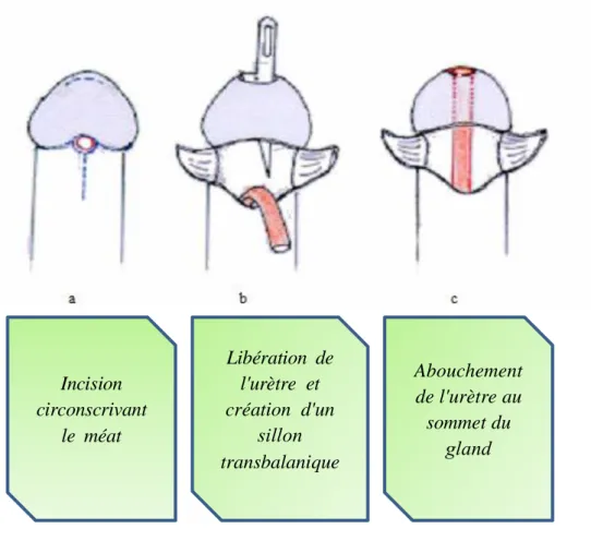 Figure 21 : Technique de BECK  [98] .