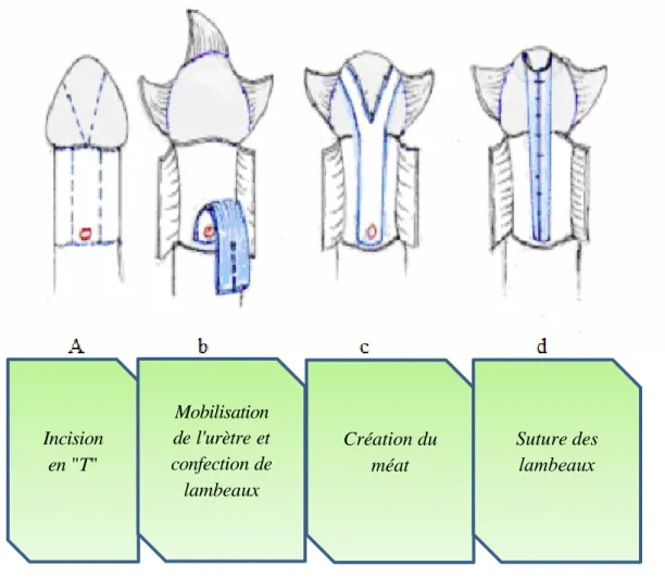 Figure 22 : Technique de HORTON [98] 