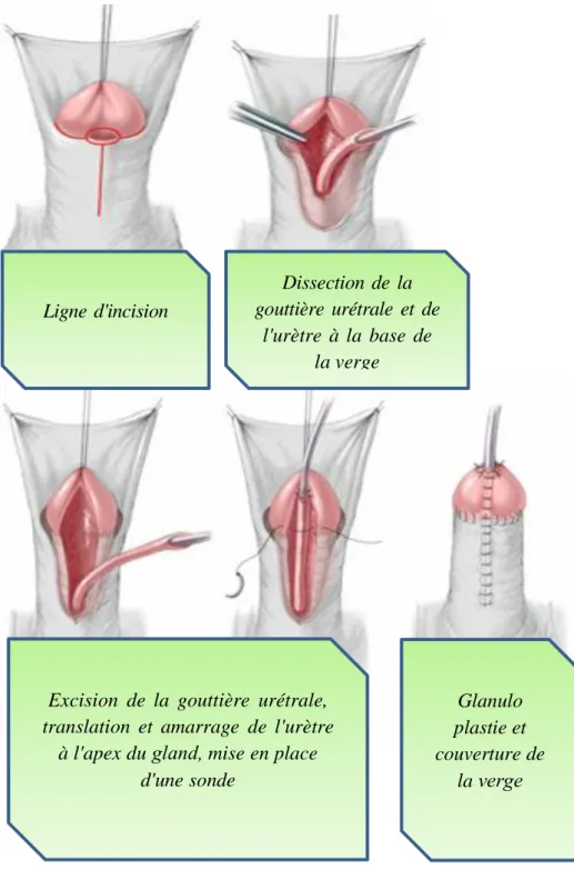 Figure 23 : Translation Urétrale de Koff [74] 