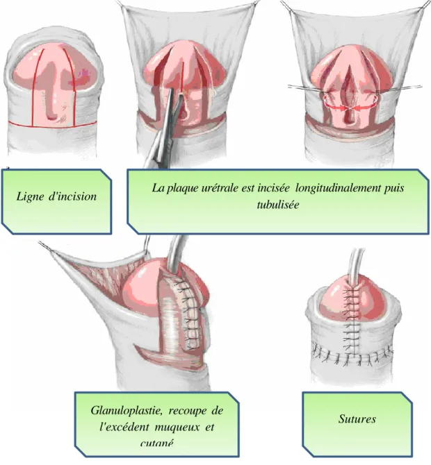 Figure 26: Technique de Snodgrass [74] 