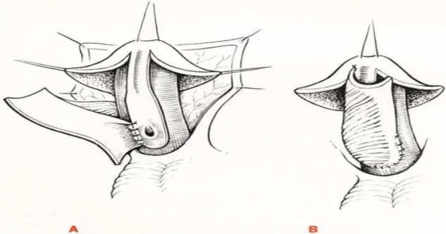Figure 28 : technique d’Onlay [82] 
