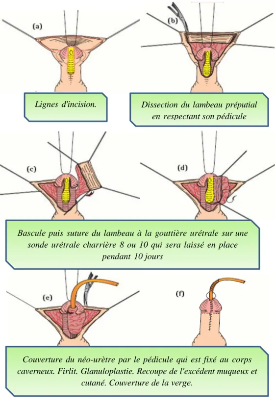 Figure 29 : Technique du lambeau en onlay. [108] 
