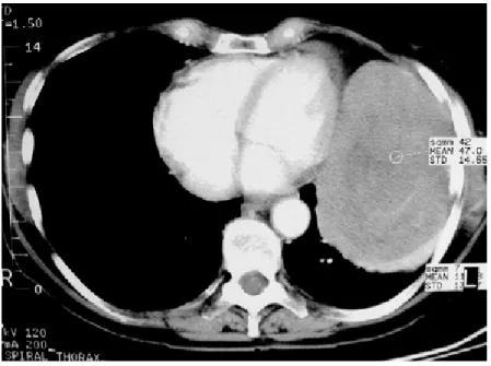 Fig 12: TFSP prenant naissance de la plèvre         Fig.13: TFSP  simulant une tumeur de la   viscérale de la partie médiastinale du lobe             paroi thoracique