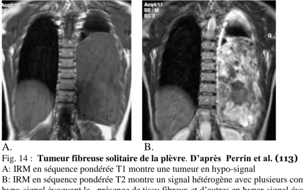 Fig. 14 :  Tumeur fibreuse solitaire de la plèvre. D’après  Perrin et al. (113)  A: IRM en séquence pondérée T1 montre une tumeur en hypo-signal  