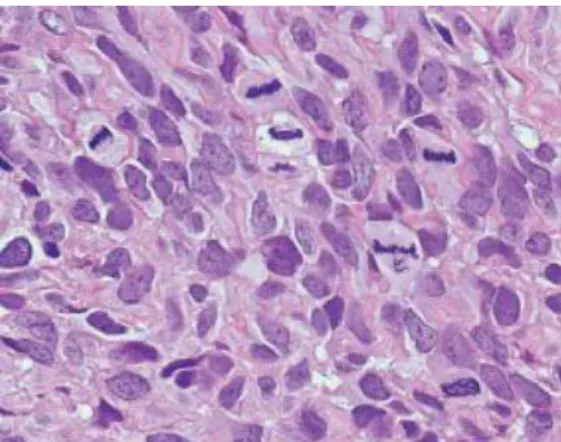 Fig. 27 : Positivité diffuse au CD34 typique de la vaste majorité  (90-95%) des TFSP. 
