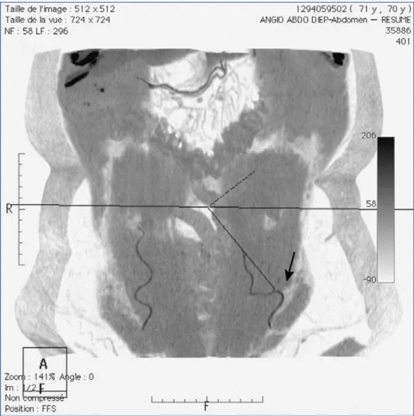 Figure 21  : Imagerie par angioscanner du réseau épigastrique: imjection intraveineuse de  produit de contraste iodé (Iomeron® 400) à haute concentration (irradiation : 6 mSv),  repérage du bolus au niveau de l’artère fémorale commune, scanner caudocrânial