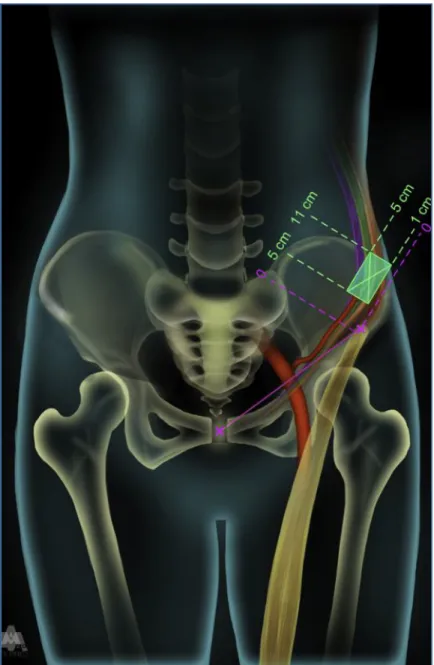 Figure  24  : Iconographie des groupements de  perforantes de l’artère CIRCONFLEXE ILIAQUE