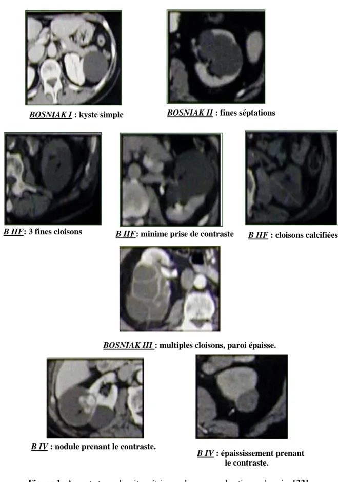 Figure 1: Aspects tomodensitométriques des masses kystiques du rein. [33] 