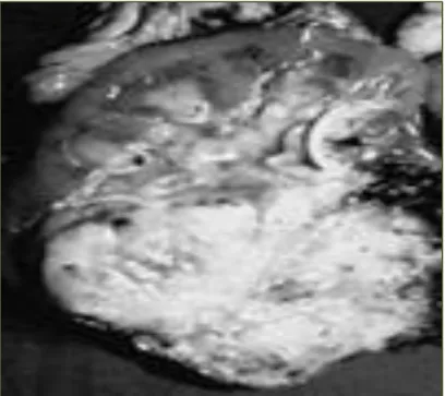 Figure 11 : Carcinome de Bellini : Tumeur mal limitée infiltrant de façon  massive le parenchyme rénal