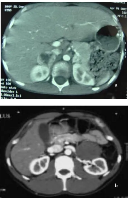 Figure 5. TDM abdominales de phéochromocytomes : 