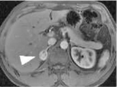 Figure 6. IRM d’un phéochromocytome droit. 