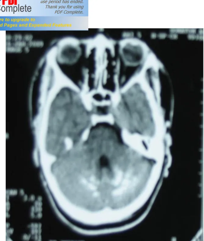 Figure 4 : Tomodensitométrie cérébrale: Calcifications des noyaux dentelés au niveau  de la fosse cérébrale postérieure