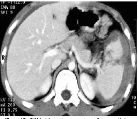 Figure  17 :  TDM  abdominale  montrant  une  fracture  splénique  comminutive 
