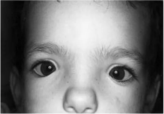 Fig.  27 : Syndrome de Waardenburg type 1 chez un garçon de 3 ans ;  télécanthusavec distance intercanthale interne (DICI) DICI égale à 42 mm [20]