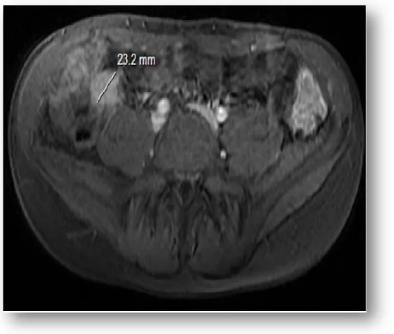 Figure 2 : image d'entéro-IRM en coupe transversale, T2 avec injection de gadolinium,  montrant une masse de la jonction iléocoecale se réhaussant après injection du produit de 