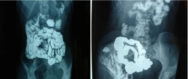 Fig 13 : montrant un transit de grêle où il n’y a aucun signe d’atteinte intestinale  