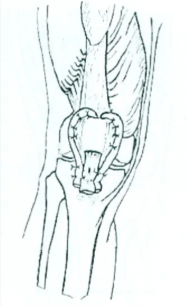 Figure 33 : Technique de March 