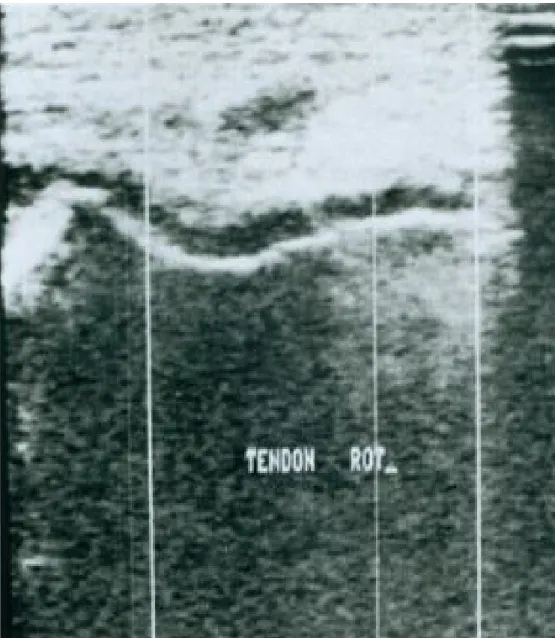 Figure 19 : Image échographique du tendon rotulien 