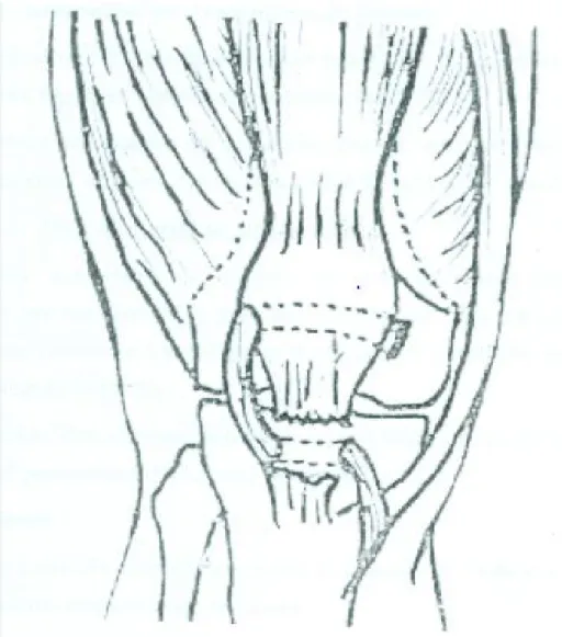 Figure 28 : Technique de KELIKIAN 