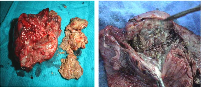 Figure 3: 2 pièces opératoires de la truffe aspergillaire   dans une cavité séquellaire chez 2 patients de notre série : 