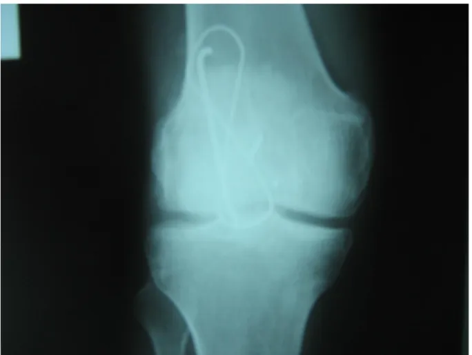 Figure  5:  radiographie  de  face  du  genou  du  patient  numéro  9  qui  montre  un  embrochage  haubanage au niveau de la rotule