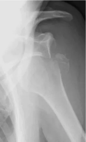 fig9 : luxation de l’épaule associée à une fracture du trochiter 