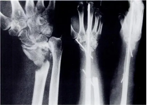 Figure 2 : radiographies standard d’un patient avant et après transposition de l’ulna