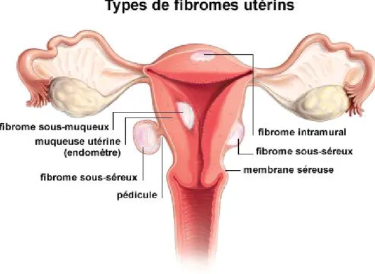 Figure n° 1: Classification des fibromes utérins 