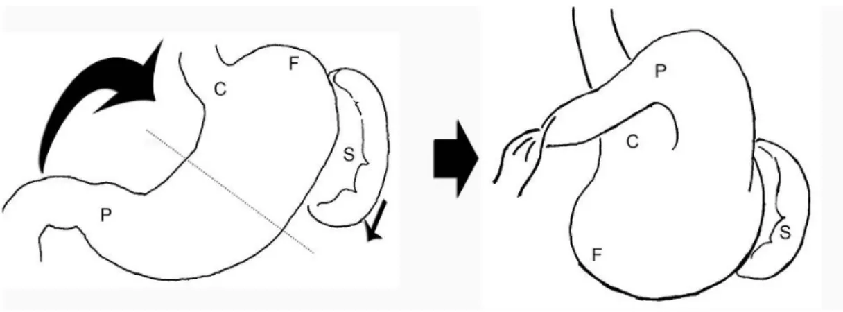 Figure 7 : Représentation diaphragmatique du volvulus gastrique   mésentérico-axial (36) : 