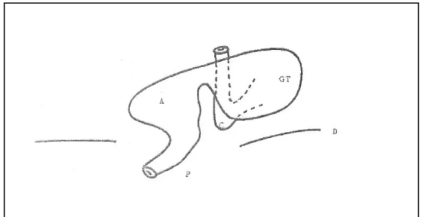 Figure 8a : volvulus gastrique total  GT : La grande courbure 
