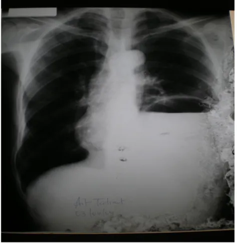 Figure 9 : Radio pulmonaire de face montrant un niveau hydro-aérique intra- intra-thoracique