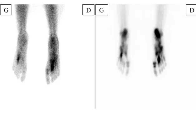 Figure  3:  scintigraphie  osseuse  au  temps  précoce  et  tardif,  centrée  sur  les  parties  distales  des  membres  inferieurs  (face  plantaire)  montrant  des hyperfixations diffuses